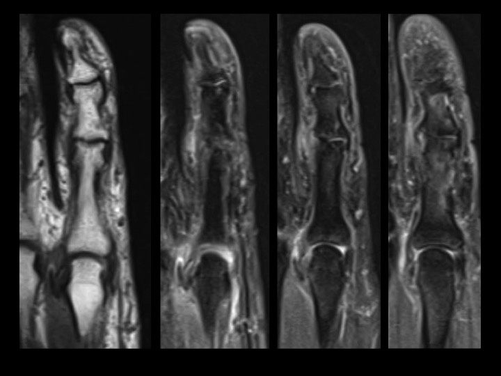 Figure 2 for case radial collateral ligament of metacarpophalangeal joint ( RID2335 )